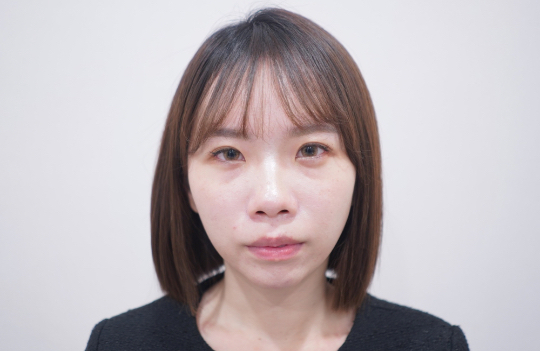 隱痕眼袋手術Before